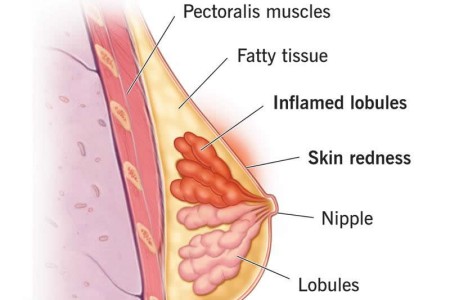 Mastitis
