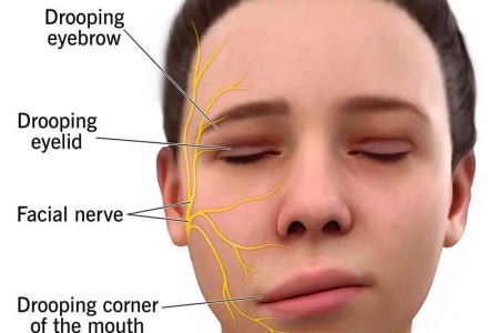 Bell’s Palsy