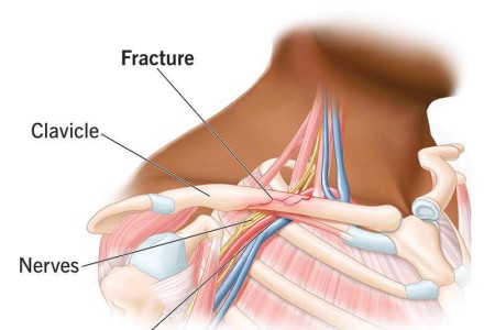 Clavicle Fracture (Broken Collarbone)