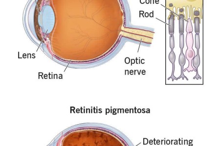 Retinitis Pigmentosa