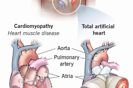 Artificial Heart