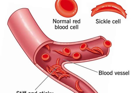 Sickle Cell Anemia