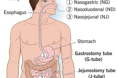 Tube Feeding (Enteral Nutrition)