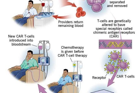 CAR T-Cell Therapy