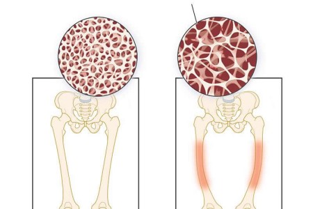 Osteomalacia