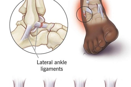Sprains