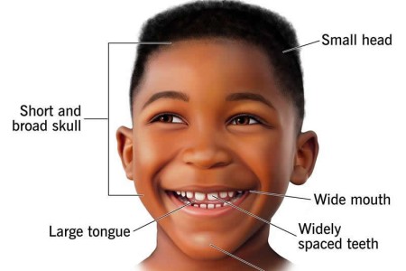 Angelman Syndrome