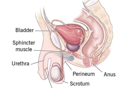 Urethrocutaneous Fistula