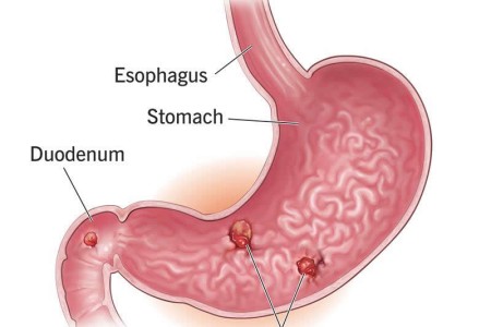 Stomach Ulcer