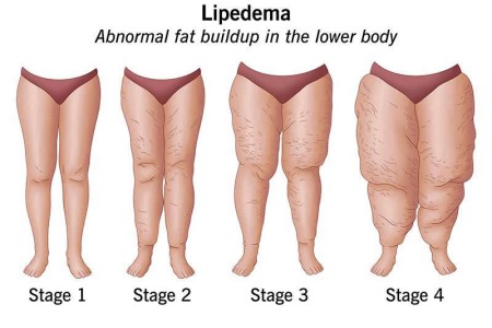 Lipedema