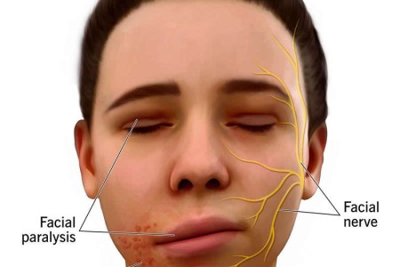 Ramsay Hunt Syndrome