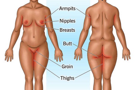 Chafing