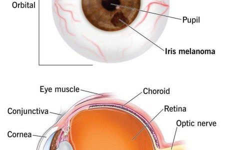 Eye Cancer