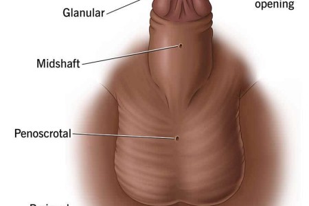Hypospadias