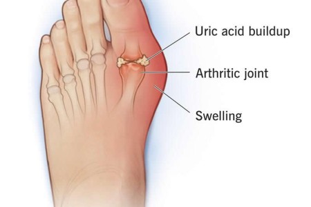 Gout