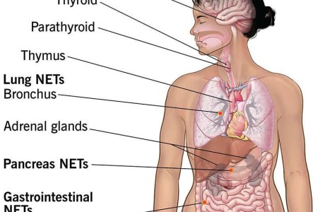 Neuroendocrine Tumors