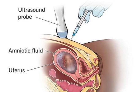 Amniocentesis