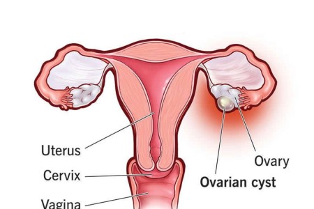 Ovarian Cysts