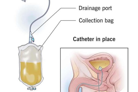 Foley Catheter