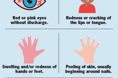 Kawasaki Disease