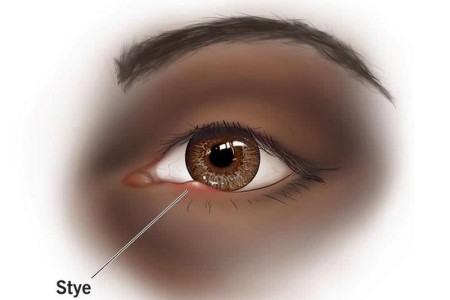 Stye