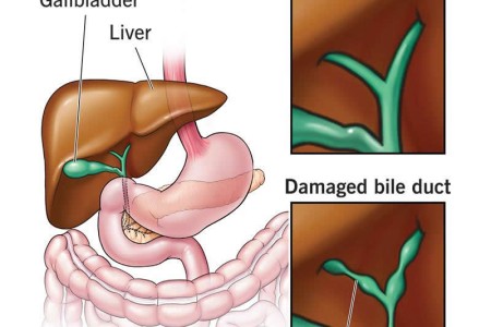 Primary Sclerosing Cholangitis