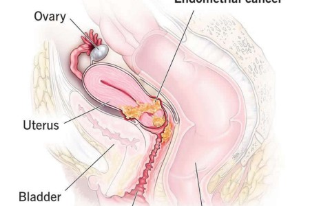 Uterine Cancer (Endometrial Cancer)