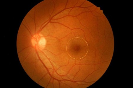 Macular Hole