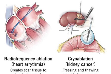 Ablation Therapy