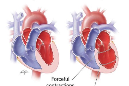Broken Heart Syndrome