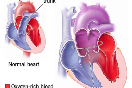 Truncus Arteriosus