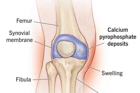 Pseudogout (Chondrocalcinosis or CPPD)