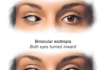 Esotropia