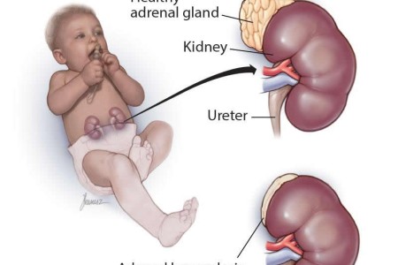 Congenital Adrenal Hyperplasia