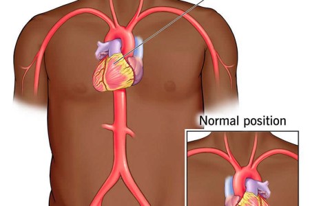 Dextrocardia