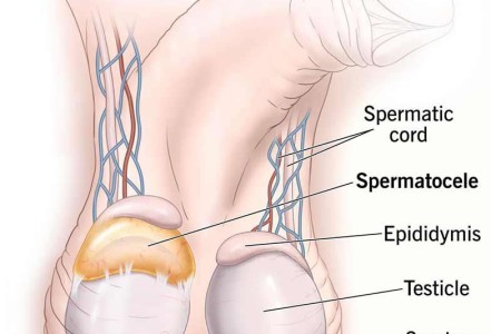 Spermatocele