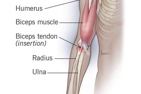 Bicep Tendonitis