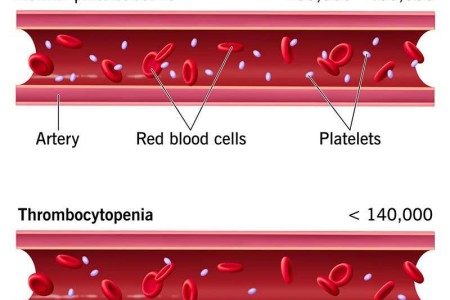 Thrombocytopenia