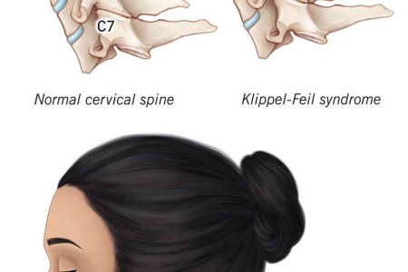 Klippel-Feil Syndrome (KFS)