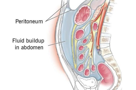 Ascites