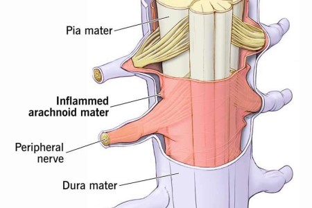 Arachnoiditis