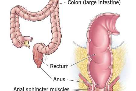 Fecal (Bowel) Incontinence