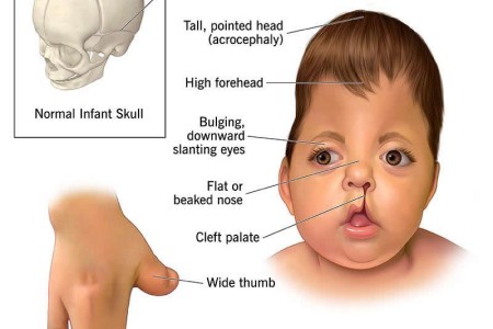 Apert Syndrome