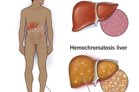 Hemochromatosis (Iron Overload)