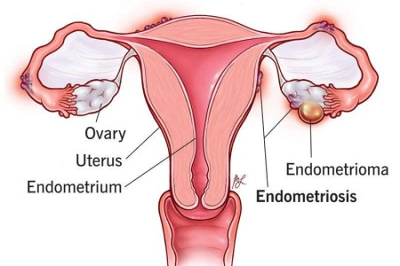 Endometriosis