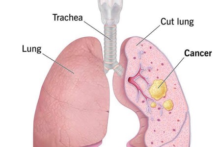 Small Cell Lung Cancer