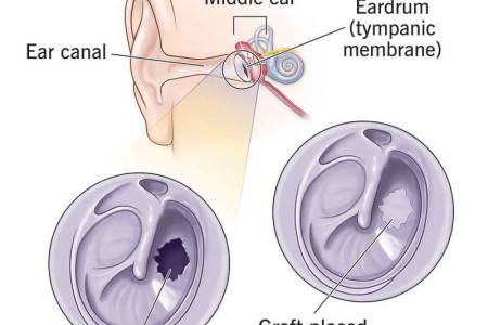 Tympanoplasty