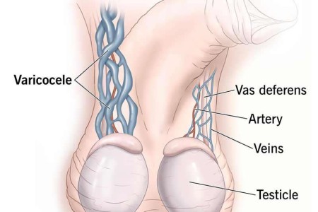 Varicocele