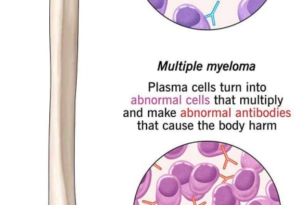 Multiple Myeloma