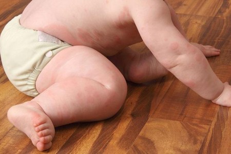 Skin Rashes in Kids
